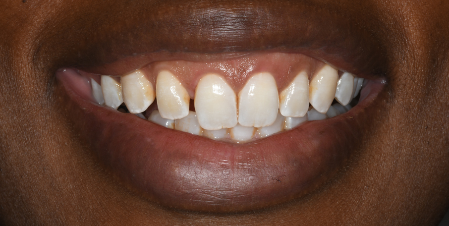 Before Treatment 
