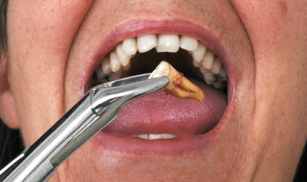 how to manage pain and recover after a tooth extraction