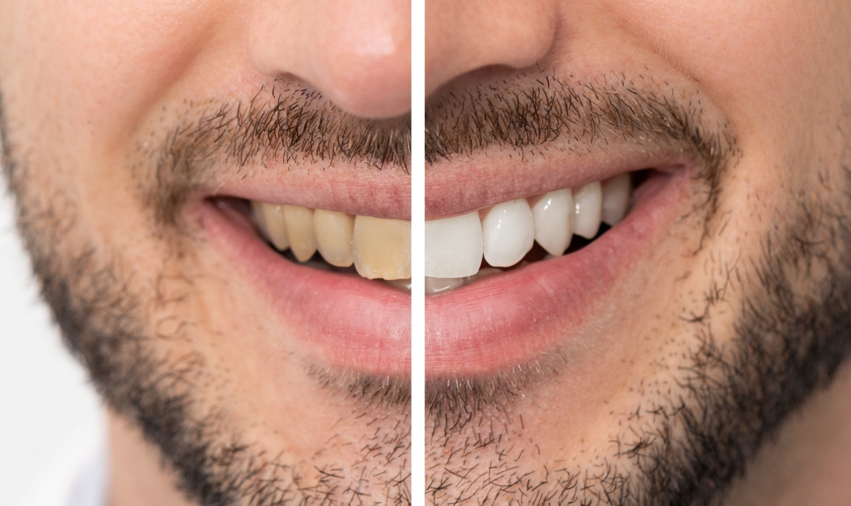 is it alright to drink alcohol after teeth whitening